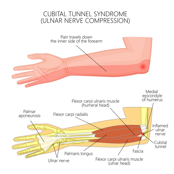 cubital tunnel syndrome